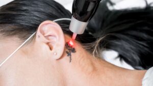 laser tattoo removal in columbus ohio