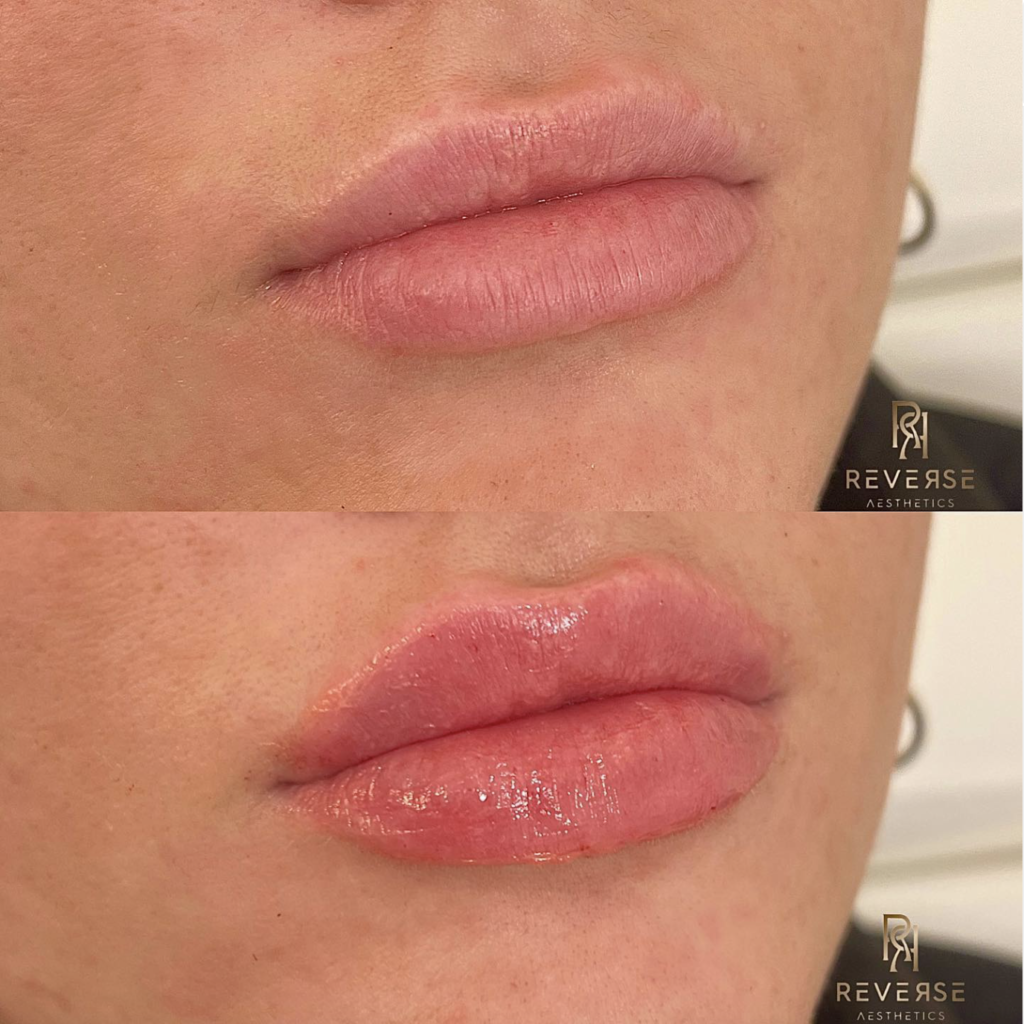 Lip Filler in Columbus, Ohio