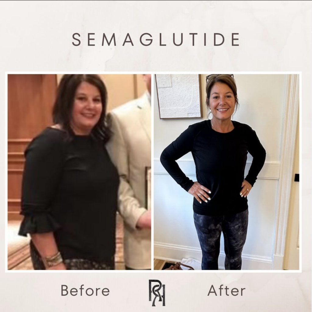 Semaglutide results, before and after.